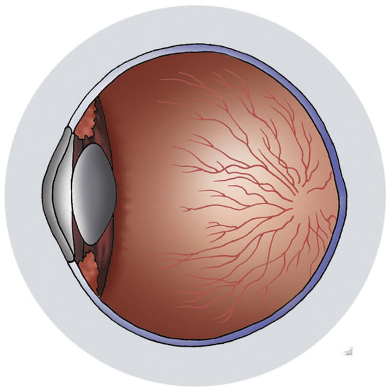 VSVZ82SI-zvisan-krvni-tlak-Krka-okvara-oci-c800x800